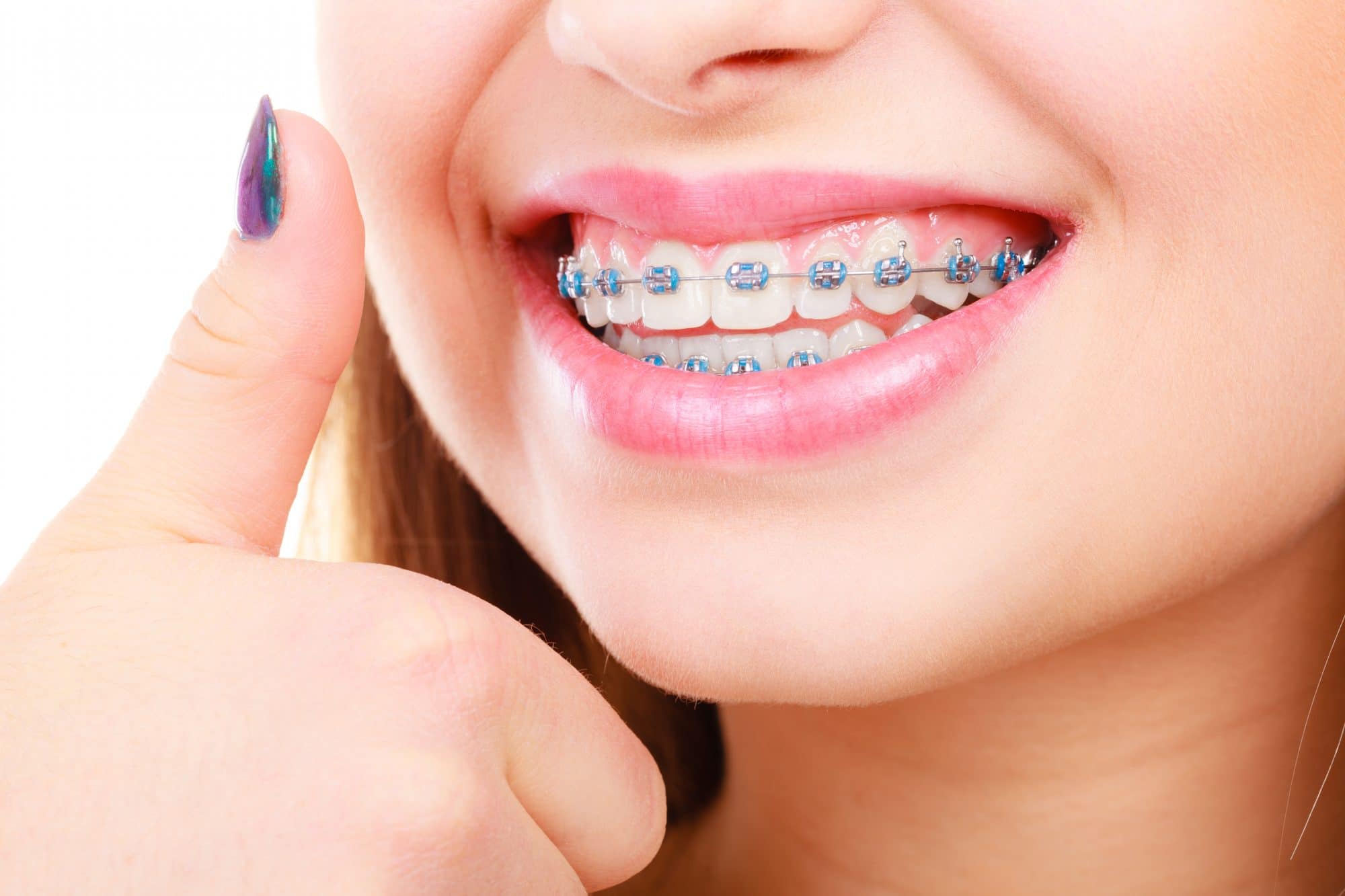 Брекеты на зубы для детей сколько стоят. Ортодонтические брекеты.